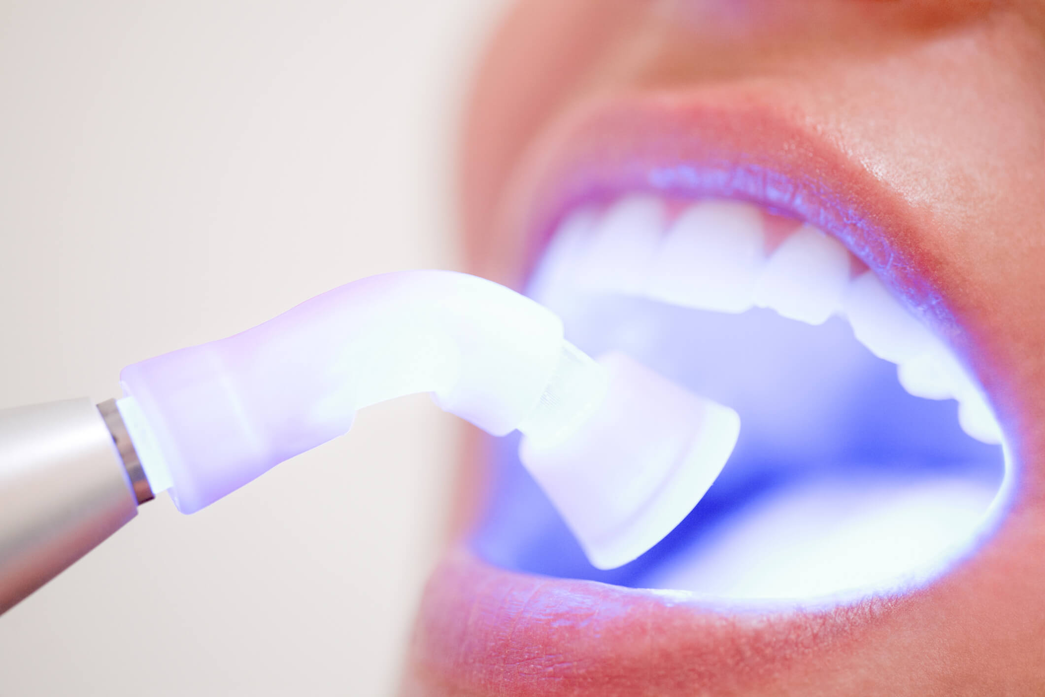 307864-especialista-explica-como-funciona-o-clareamento-dental